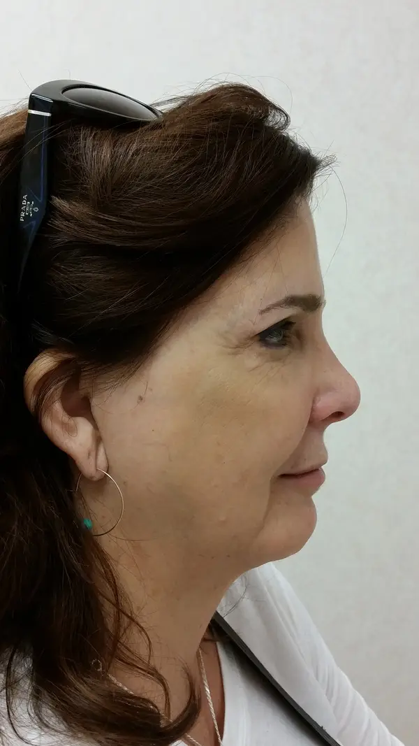 Rhinoplasty — after photo, right profile, Dr. Faramarz Shabdiz, MD, Orange County, CA. Individual results vary.