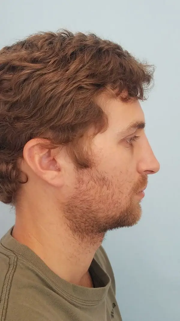 Rhinoplasty — after, right profile — Dr. Faramarz Shabdiz, MD. Individual results vary.