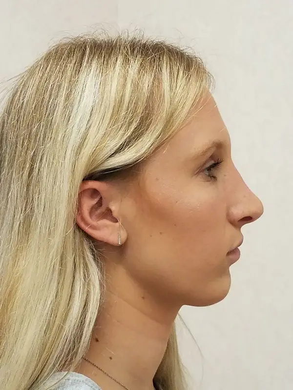 Rhinoplasty — after, right profile — Dr. Faramarz Shabdiz, MD. Individual results vary.