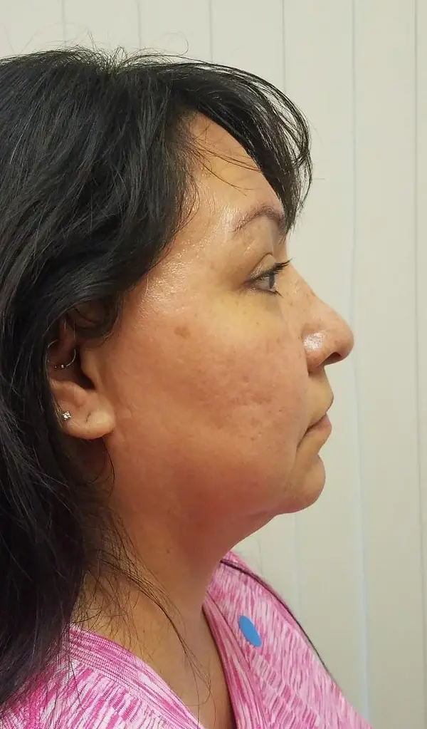 Rhinoplasty — after photo, right profile, Dr. Faramarz Shabdiz, MD, Orange County, CA. Individual results vary.