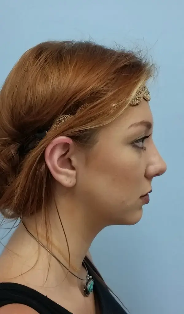 Rhinoplasty — after, right profile — Dr. Faramarz Shabdiz, MD. Individual results vary.