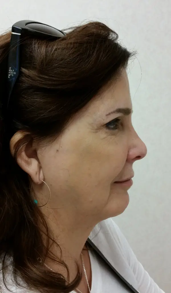 Rhinoplasty — after, right profile — Dr. Faramarz Shabdiz, MD. Individual results vary.