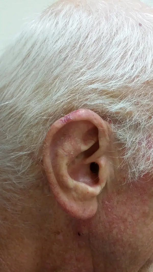 Facial reconstruction — after — Dr. Faramarz Shabdiz, MD. Individual results vary.