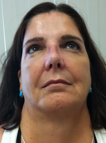 Additional Results — after photo, base view, Dr. Faramarz Shabdiz, MD, Orange County, CA. Individual results vary.