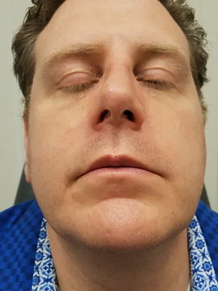 Additional Results — after photo, base view, Dr. Faramarz Shabdiz, MD, Orange County, CA. Individual results vary.
