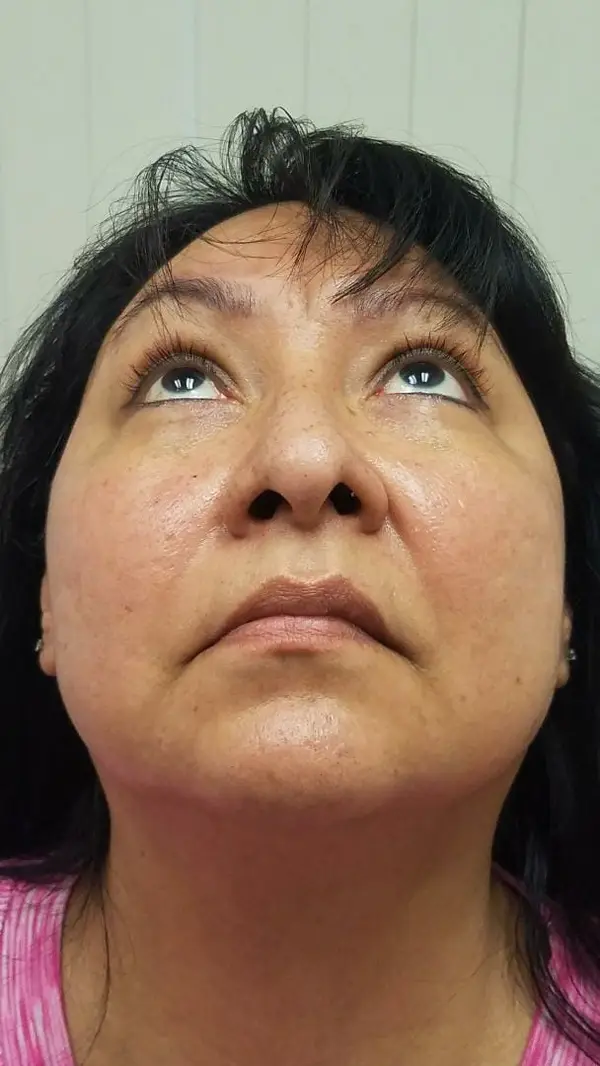 Rhinoplasty — after photo, base view, Dr. Faramarz Shabdiz, MD, Orange County, CA. Individual results vary.