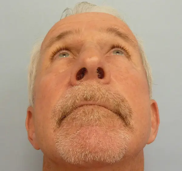 Rhinoplasty — after, base view — Dr. Faramarz Shabdiz, MD. Individual results vary.