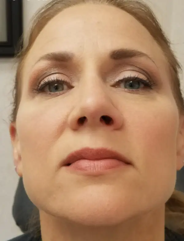 Rhinoplasty — after, base view — Dr. Faramarz Shabdiz, MD. Individual results vary.