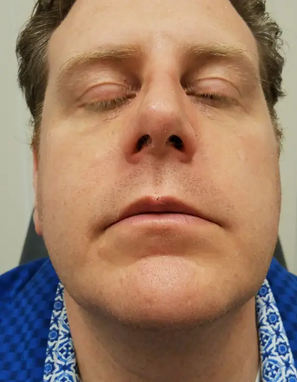 Rhinoplasty — after, base view — Dr. Faramarz Shabdiz, MD. Individual results vary.