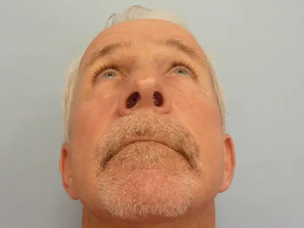 Rhinoplasty — after photo, base view, Dr. Faramarz Shabdiz, MD, Orange County, CA. Individual results vary.