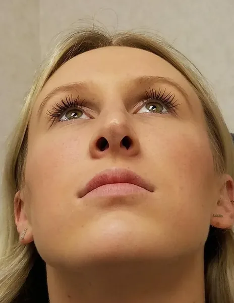 Rhinoplasty — after, base view — Dr. Faramarz Shabdiz, MD. Individual results vary.