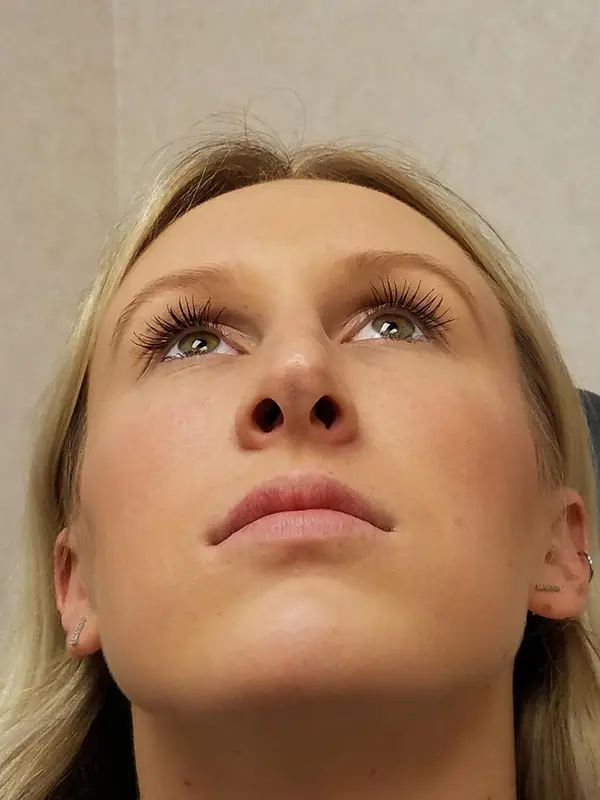 Rhinoplasty — after photo, base view, Dr. Faramarz Shabdiz, MD, Orange County, CA. Individual results vary.
