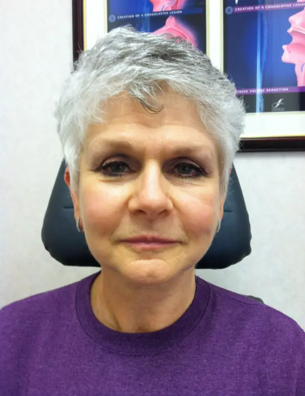 Rhinoplasty — after — Dr. Faramarz Shabdiz, MD. Individual results vary.
