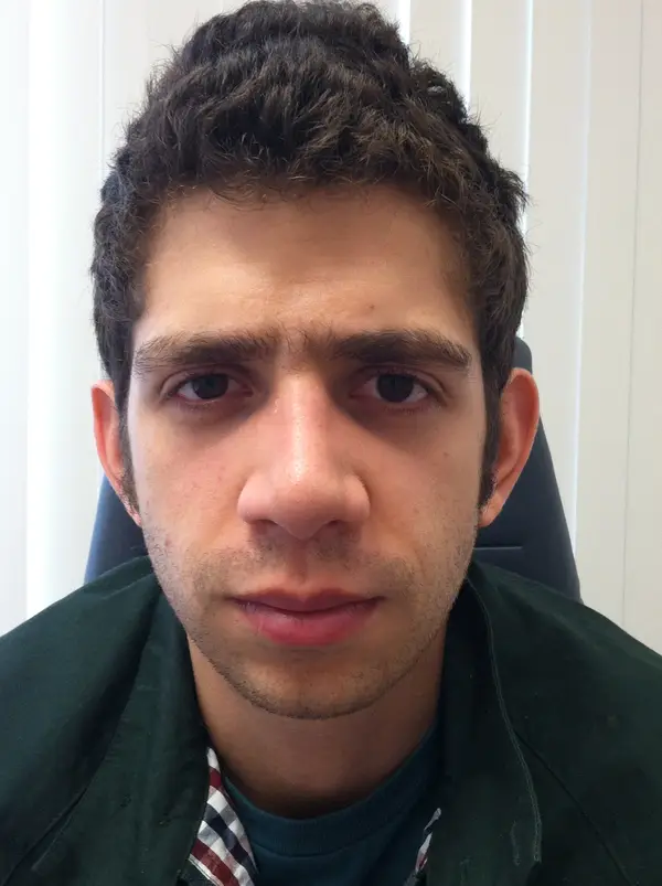 Rhinoplasty — after — Dr. Faramarz Shabdiz, MD. Individual results vary.