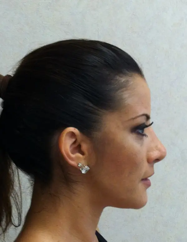 Rhinoplasty — after — Dr. Faramarz Shabdiz, MD. Individual results vary.