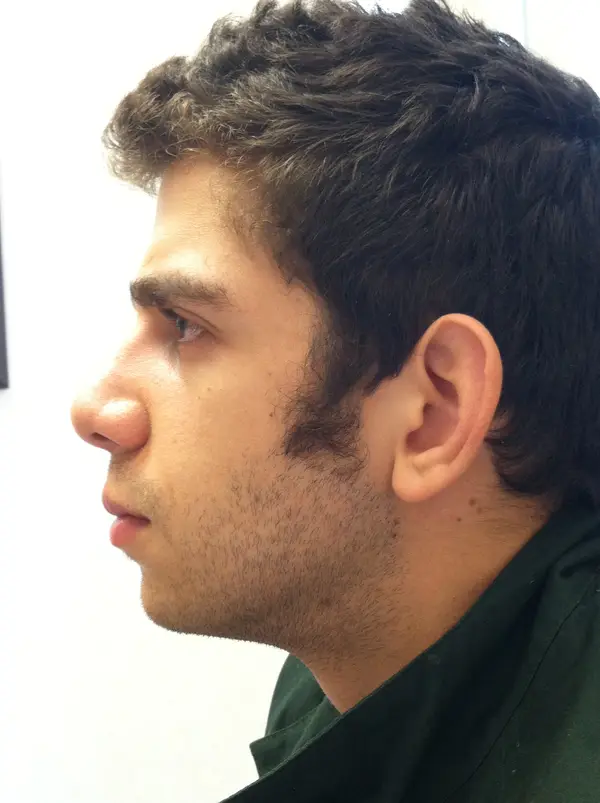 Facial Tumor & Reconstruction — after photo, Dr. Faramarz Shabdiz, MD, Orange County, CA. Individual results vary.
