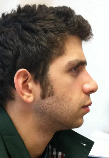 Additional Results — after photo, Dr. Faramarz Shabdiz, MD, Orange County, CA. Individual results vary.