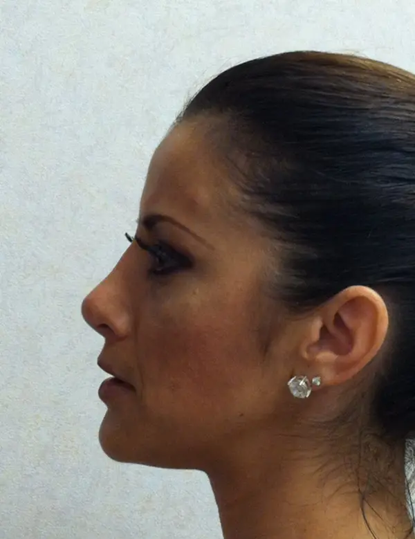 Rhinoplasty — after — Dr. Faramarz Shabdiz, MD. Individual results vary.
