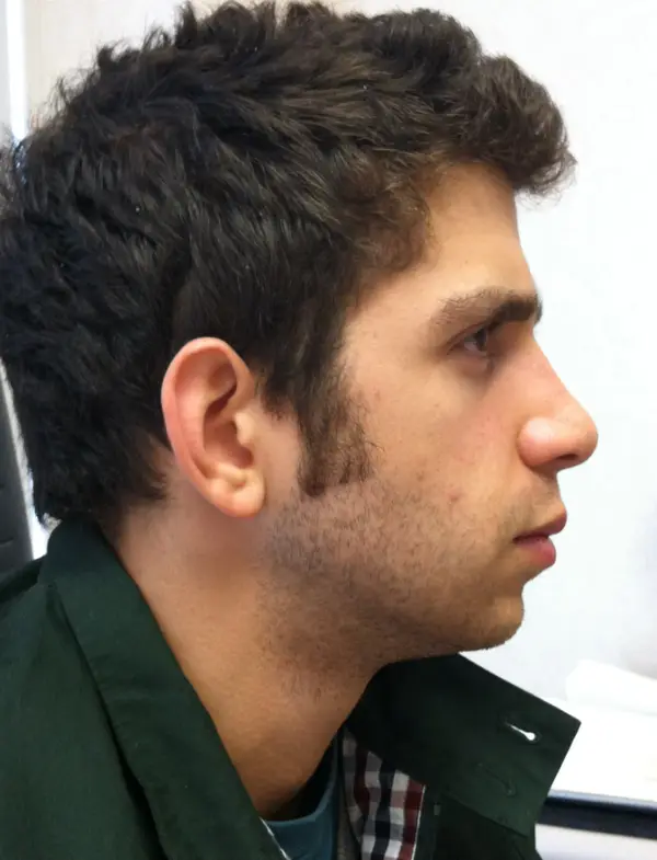 Rhinoplasty — after — Dr. Faramarz Shabdiz, MD. Individual results vary.