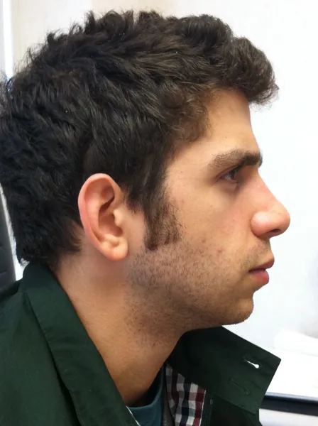 Additional Results — after photo, Dr. Faramarz Shabdiz, MD, Orange County, CA. Individual results vary.
