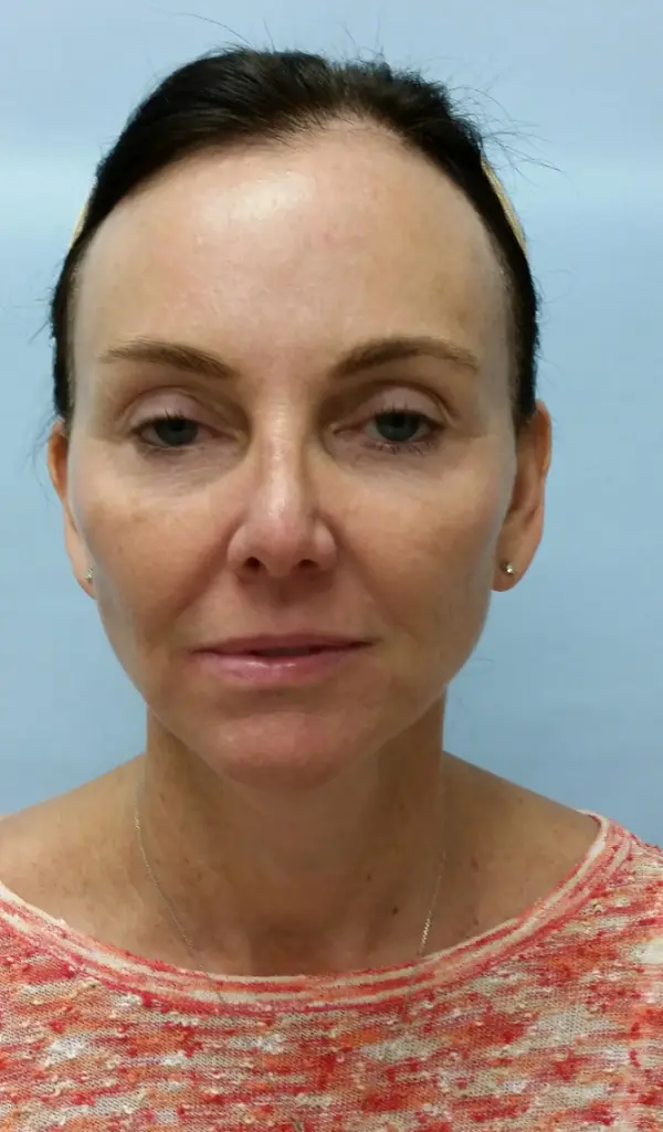 Rhinoplasty — after, front — Dr. Faramarz Shabdiz, MD. Individual results vary.