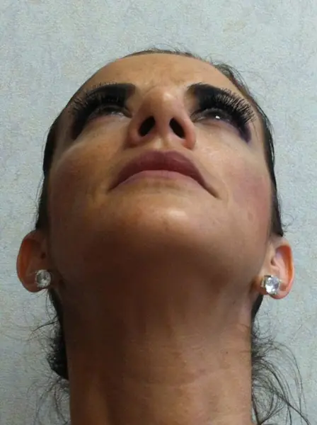 Rhinoplasty — after — Dr. Faramarz Shabdiz, MD. Individual results vary.