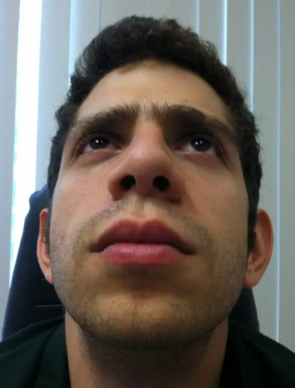 Rhinoplasty — after — Dr. Faramarz Shabdiz, MD. Individual results vary.