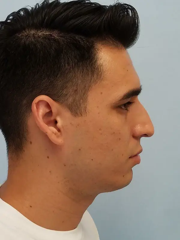 Rhinoplasty — before, right profile — Dr. Faramarz Shabdiz, MD. Individual results vary.