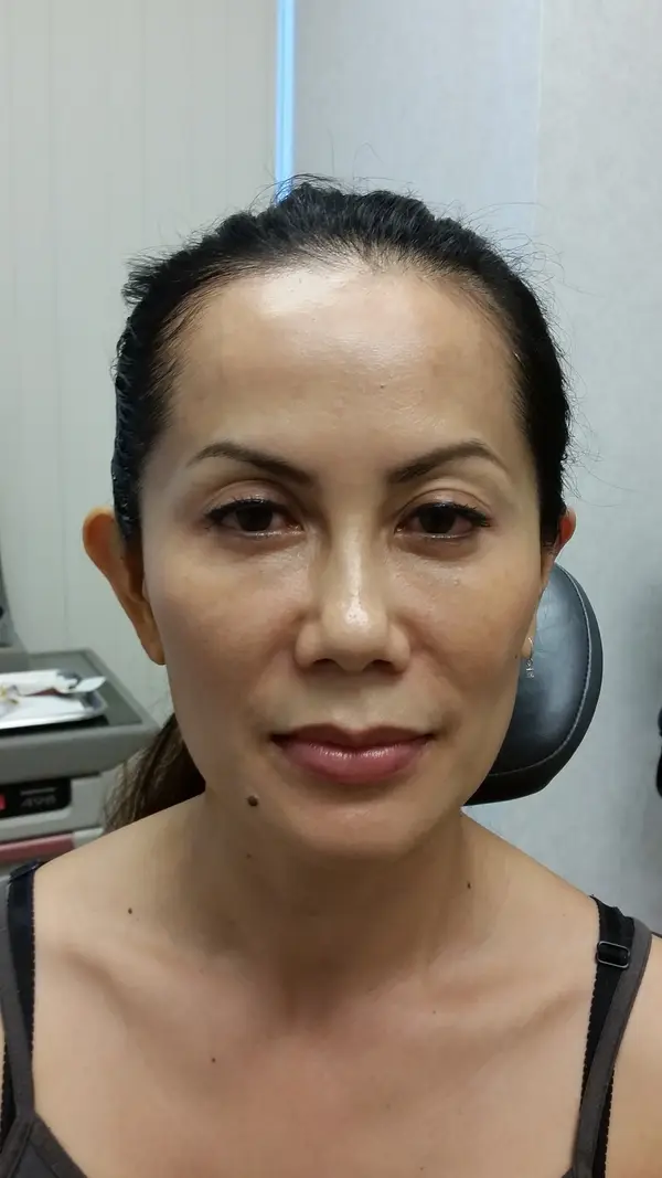 Otoplasty (ear surgery) — before, front — Dr. Faramarz Shabdiz, MD. Individual results vary.