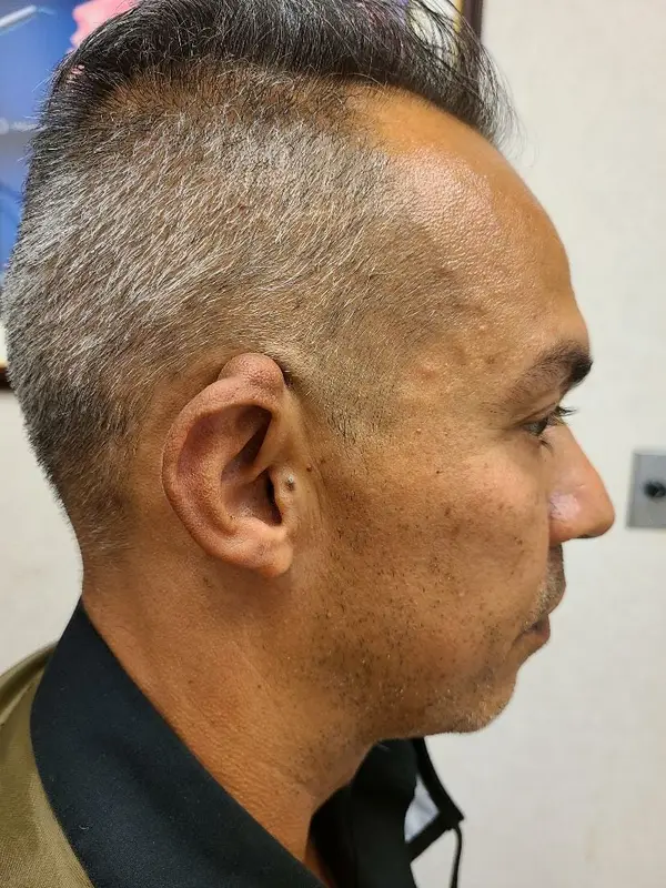 Facial Tumor & Reconstruction — before photo, Dr. Faramarz Shabdiz, MD, Orange County, CA. Individual results vary.