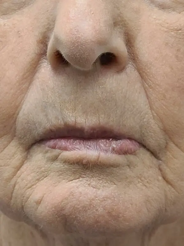 Facial Tumor & Reconstruction — before photo, Dr. Faramarz Shabdiz, MD, Orange County, CA. Individual results vary.