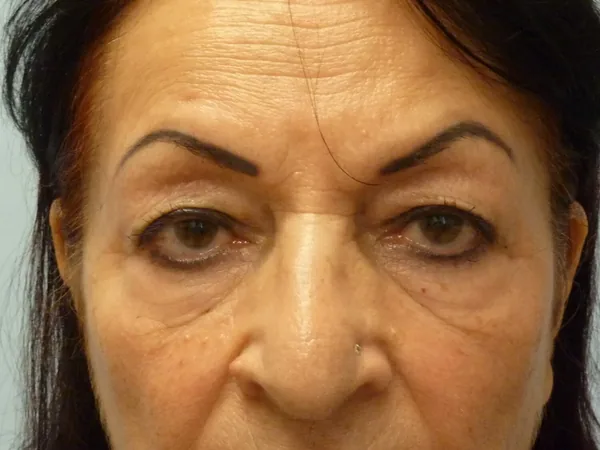Additional Results — before photo, Dr. Faramarz Shabdiz, MD, Orange County, CA. Individual results vary.