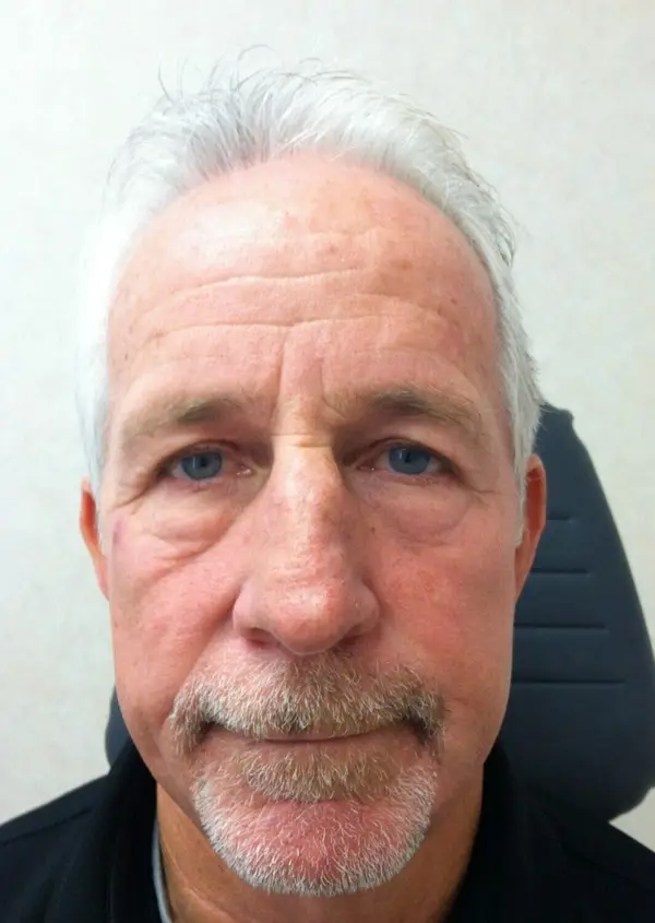Rhinoplasty — before, front — Dr. Faramarz Shabdiz, MD. Individual results vary.