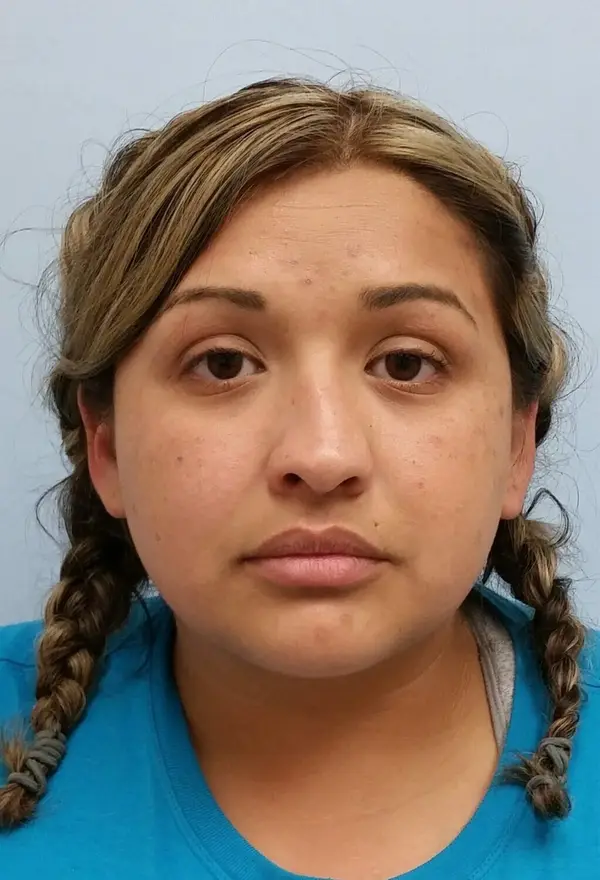 Rhinoplasty — before, front — Dr. Faramarz Shabdiz, MD. Individual results vary.