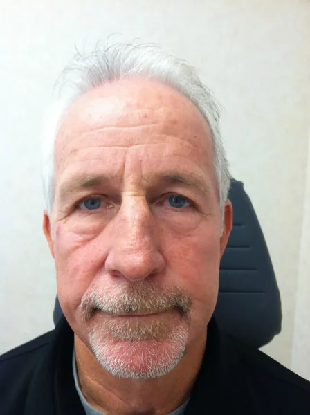 Rhinoplasty — before photo, front view, Dr. Faramarz Shabdiz, MD, Orange County, CA. Individual results vary.