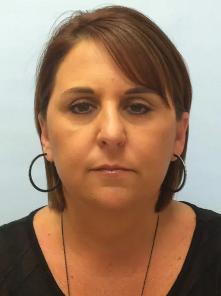 Rhinoplasty — before, front — Dr. Faramarz Shabdiz, MD. Individual results vary.