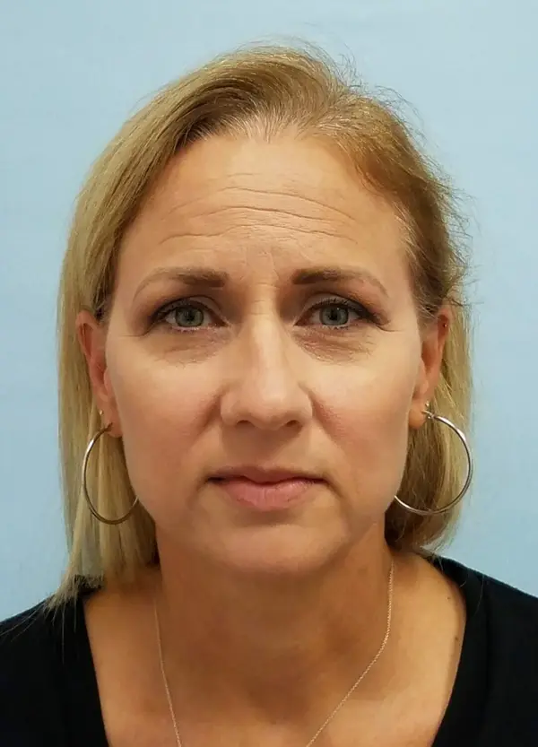 Rhinoplasty — before, front — Dr. Faramarz Shabdiz, MD. Individual results vary.