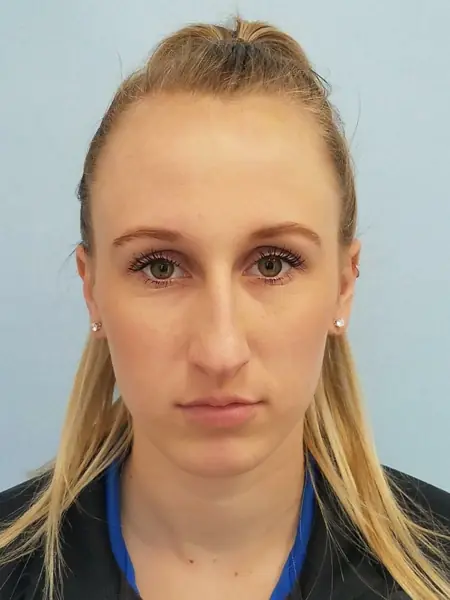 Rhinoplasty — before, front — Dr. Faramarz Shabdiz, MD. Individual results vary.