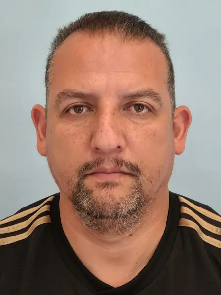 Rhinoplasty — before, front — Dr. Faramarz Shabdiz, MD. Individual results vary.