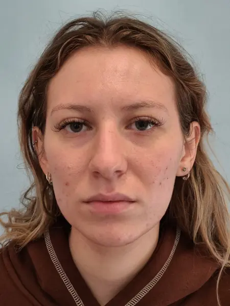 Rhinoplasty — before, front — Dr. Faramarz Shabdiz, MD. Individual results vary.