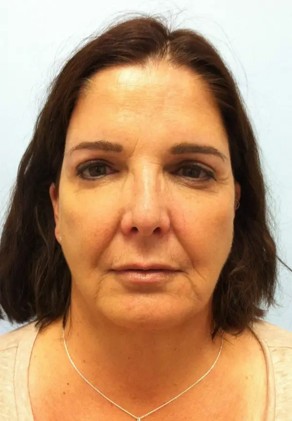 Rhinoplasty — before, front — Dr. Faramarz Shabdiz, MD. Individual results vary.