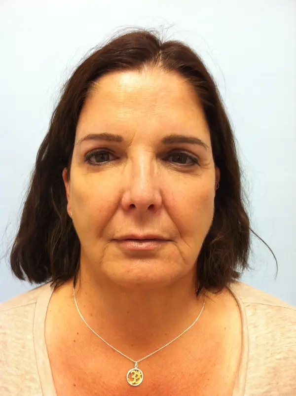 Rhinoplasty — before photo, front view, Dr. Faramarz Shabdiz, MD, Orange County, CA. Individual results vary.