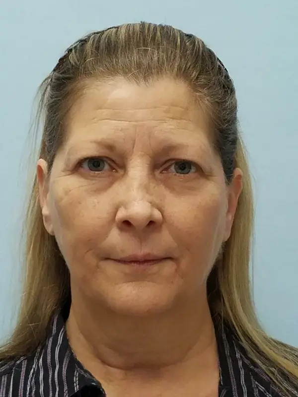 Rhinoplasty — before photo, front view, Dr. Faramarz Shabdiz, MD, Orange County, CA. Individual results vary.