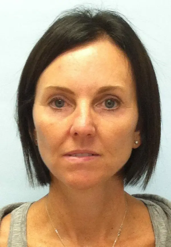 Rhinoplasty — before, front — Dr. Faramarz Shabdiz, MD. Individual results vary.