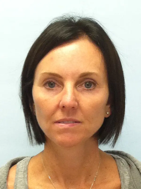 Rhinoplasty — before photo, front view, Dr. Faramarz Shabdiz, MD, Orange County, CA. Individual results vary.