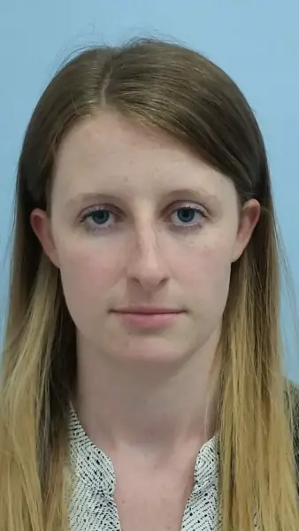 Rhinoplasty — before, front — Dr. Faramarz Shabdiz, MD. Individual results vary.