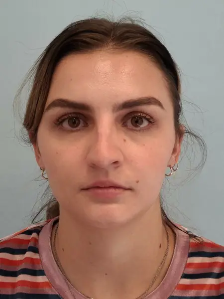 Rhinoplasty — before, front — Dr. Faramarz Shabdiz, MD. Individual results vary.