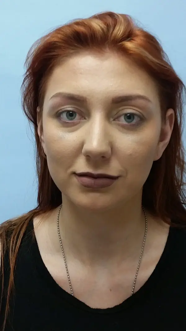 Rhinoplasty — before, front — Dr. Faramarz Shabdiz, MD. Individual results vary.