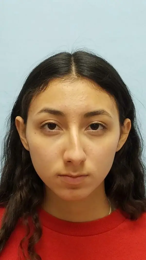 Rhinoplasty — before photo, front view, Dr. Faramarz Shabdiz, MD, Orange County, CA. Individual results vary.