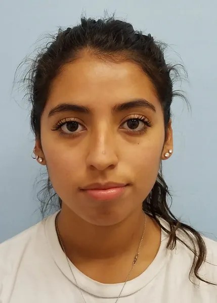 Additional Results — before photo, front view, Dr. Faramarz Shabdiz, MD, Orange County, CA. Individual results vary.